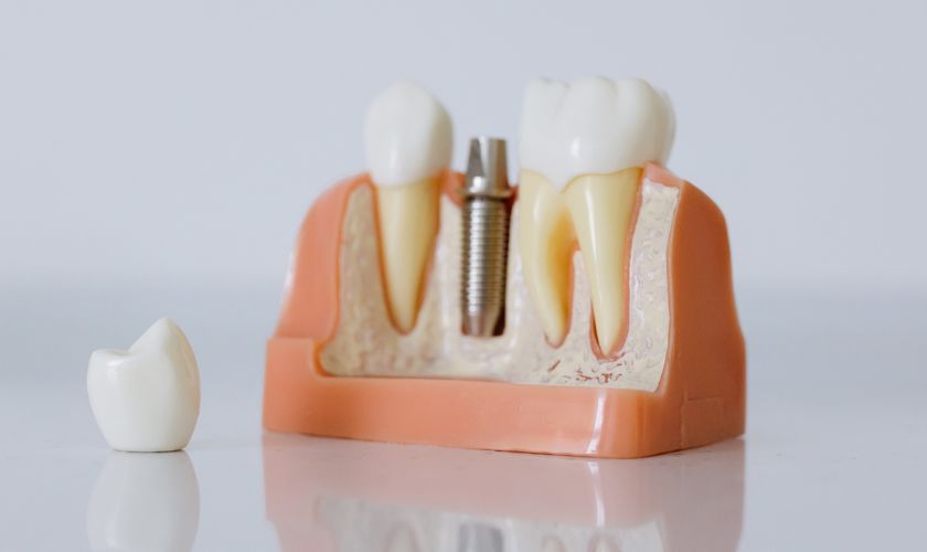 Dental Crown Fall Out